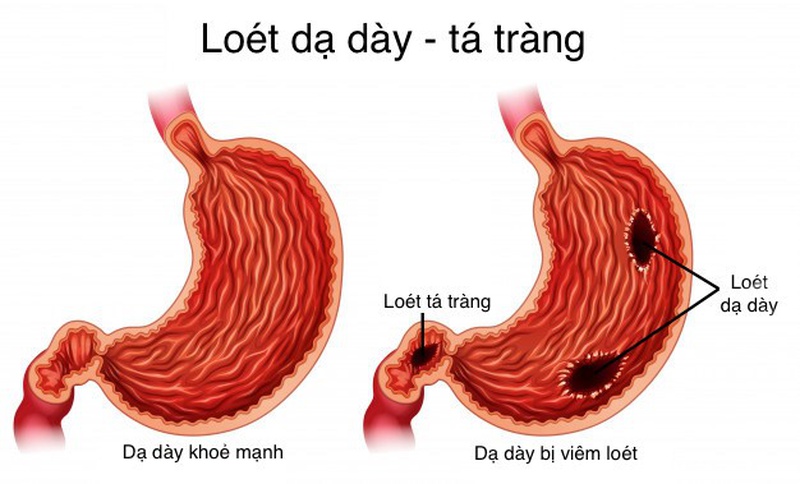 dạ dày bị loét do thức khuya