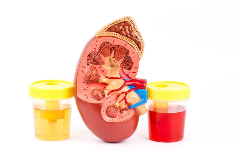 Bệnh lupus ban đỏ viêm cầu thận là gì và cách điều trị 1
