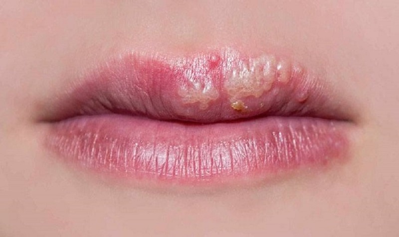 Lý do vì sao xăm môi bị lên mụn nước và cách xử lý 4
