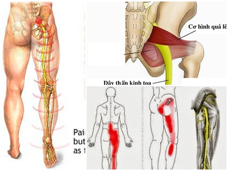 Mách bạn các cách chữa đau thần kinh tọa tại nhà hiệu quả 1