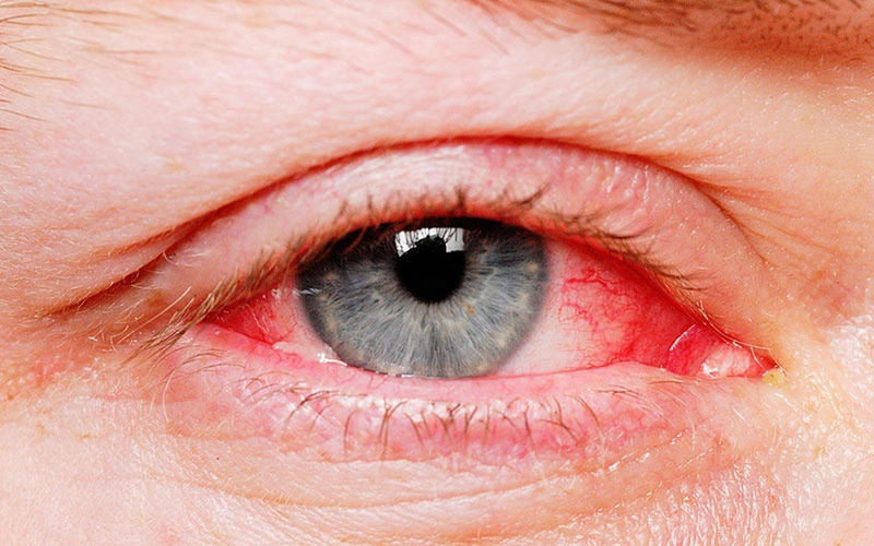 Mắt đổ ghèn: Nguyên nhân và cách điều trị 2