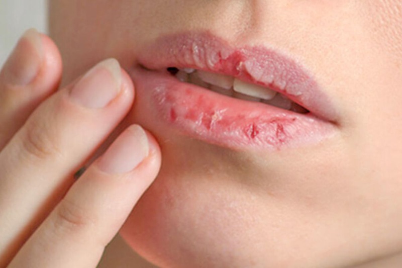 Mặt nạ môi có tác dụng gì? Những điều cần biết khi lựa chọn mặt nạ môi 2