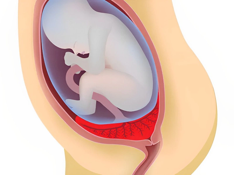 Mẹ bầu bị nhau thai bám mặt sau có gây nguy hiểm cho em bé không? 4