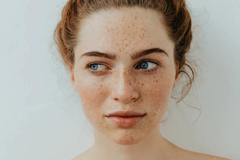 Một số cách trị tàn nhang trên da mặt đơn giản, dễ thực hiện 1