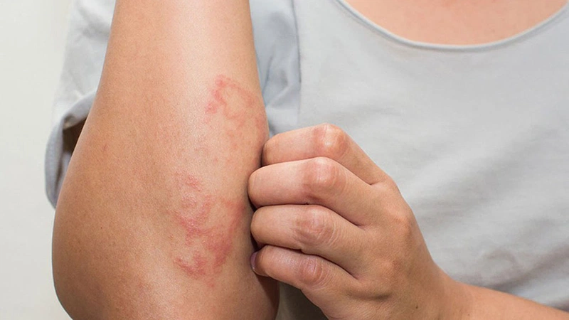 Một số tác hại không ngờ khi làn da bị khô, thiếu độ ẩm 2