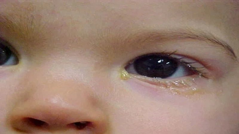 Một số thuốc nhỏ mắt cho trẻ sơ sinh bị ghèn 1