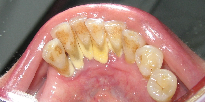 Mức độ nguy hiểm của cao răng độ 3 như thế nào 1