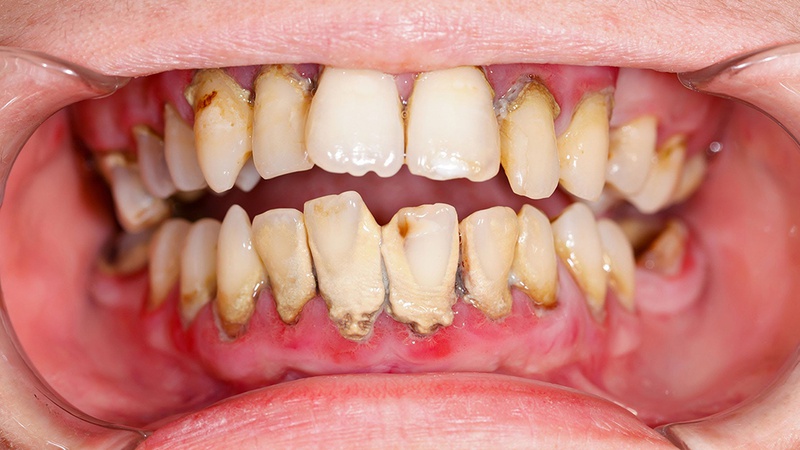 Mức độ nguy hiểm của cao răng độ 3 như thế nào 2