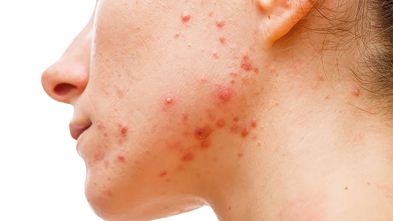 Mụn nội tiết là gì? Cách chăm sóc khi da bị nổi mụn nội tiết 1