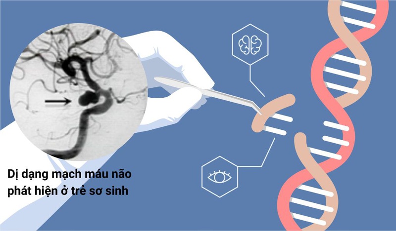 Nguyên nhân bị dị dạng mạch máu não và cách điều trị bệnh hiệu quả 2