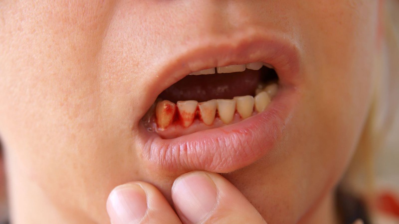 Phòng tránh chảy máu khi đánh răng