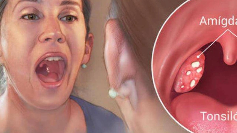 Nguyên nhân khiến viêm amidan tái phát nhiều lần