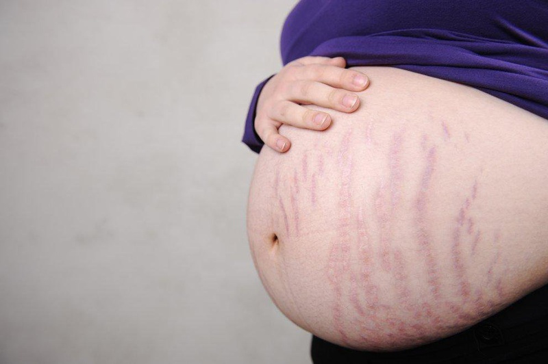 Nguyên nhân phụ nữ trong thời gian mang thai dễ bị rạn da 1