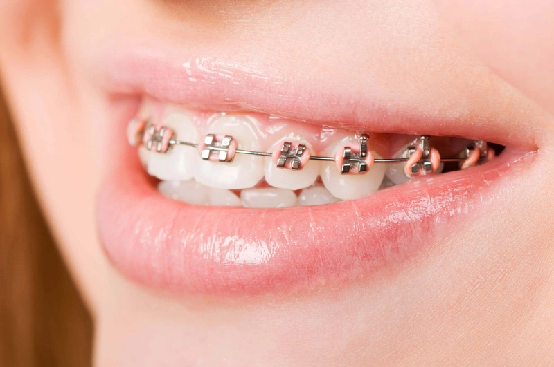 Nguyên nhân răng mọc lẫy thường gặp là gì? Cách xử lý răng mọc lẫy mà cha mẹ cần biết 3