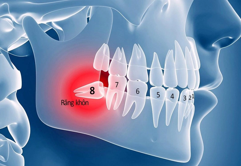 Nguyên nhân và cách điều trị sưng nướu răng trong cùng hàm dưới 4