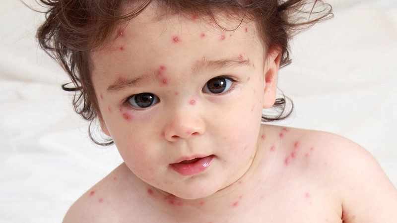 Nhận biết bệnh chốc lở ở trẻ sơ sinh và cách điều trị an toàn, hiệu quả 1