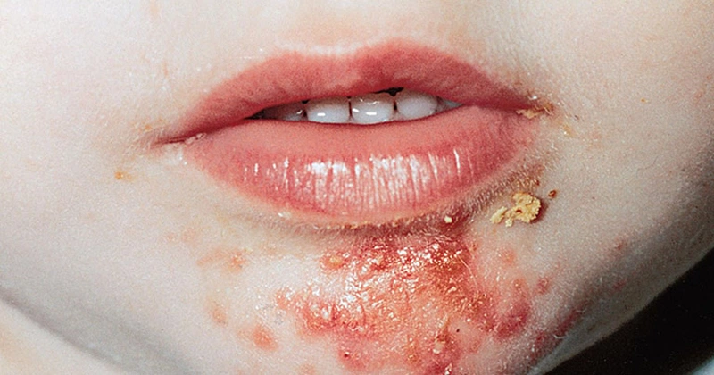 Nhận biết bệnh chốc lở ở trẻ sơ sinh và cách điều trị an toàn, hiệu quả 2