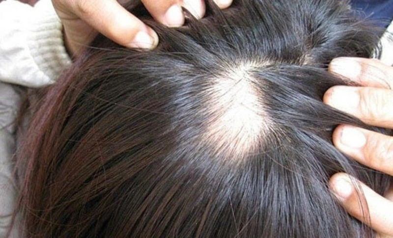 Tác hại của nhổ tóc bạc là gì? Có biện pháp nào thay thế việc nhổ tóc bạc hay không? 3