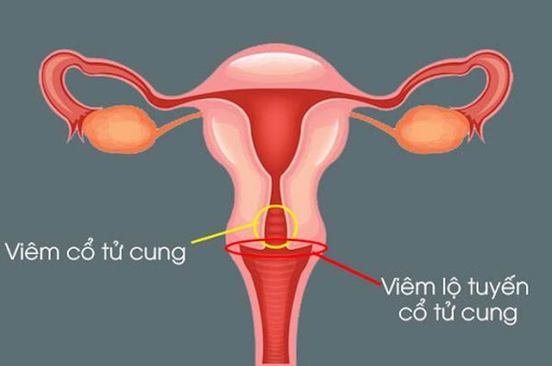 Những Chia Sẻ Về Viêm Lộ Tuyến Tử Cung Độ 3 1
