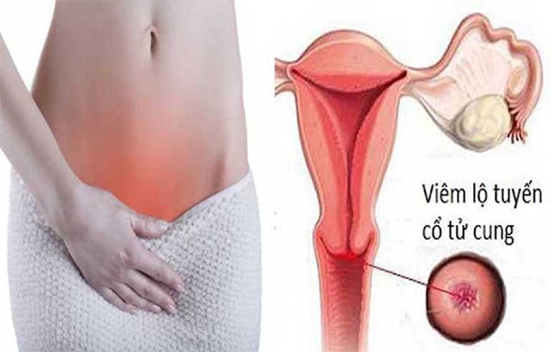 Những Chia Sẻ Về Viêm Lộ Tuyến Tử Cung Độ 3