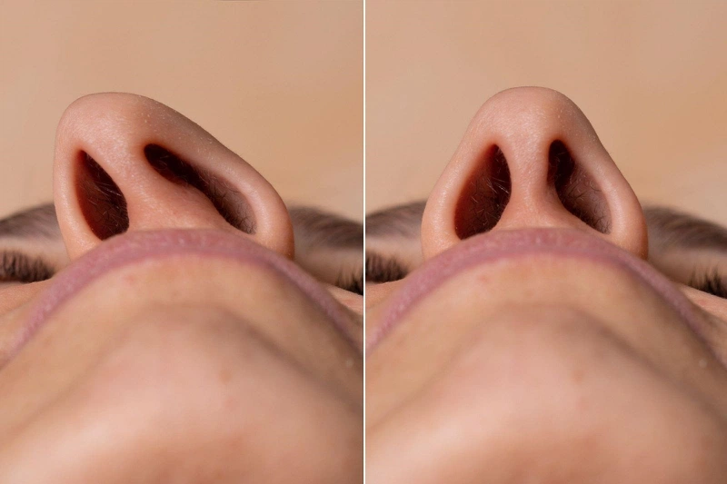 Lệch vách ngăn mũi là gì? Những điều cần biết về mổ lệch vách ngăn mũi 2