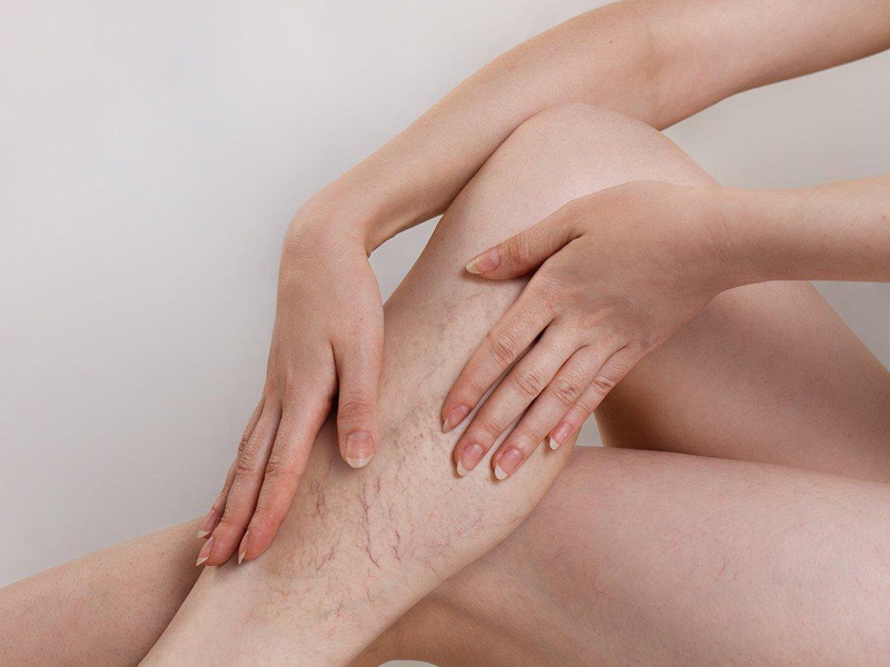 Những điều cần lưu ý khi sử dụng gel bôi suy giãn tĩnh mạch chân 3