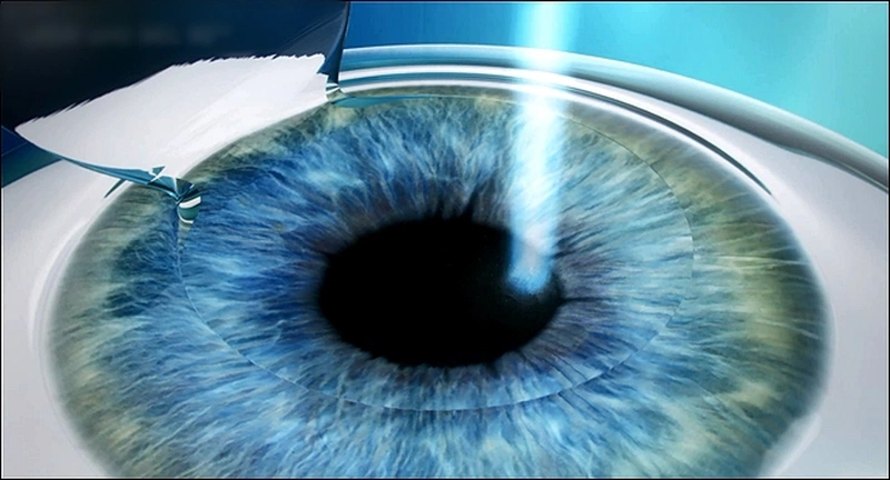 Phẫu thuật femto lasik điều trị mắt cận 1
