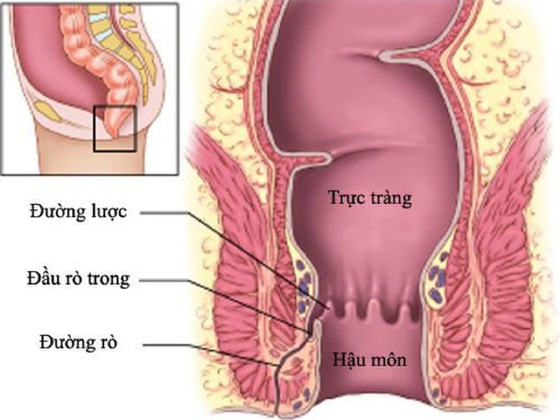 Phẫu thuật rò hậu môn có nguy hiểm không? 1