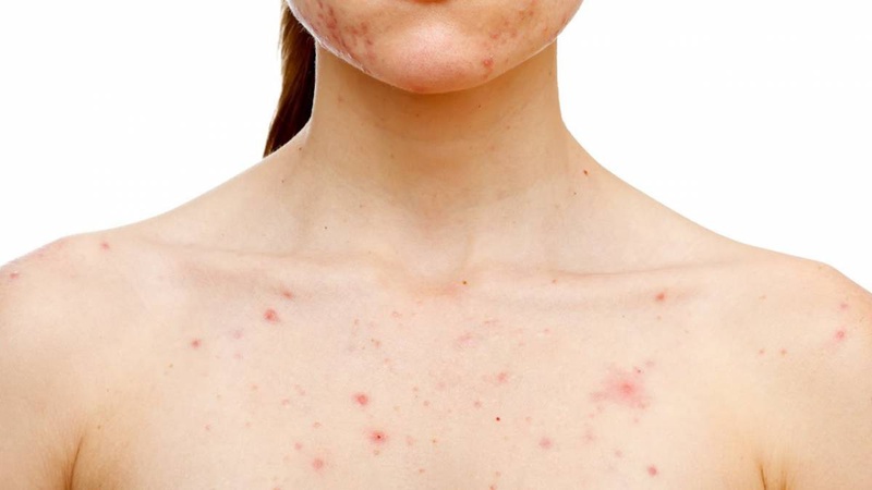 Phụ nữ sau sinh ăn cà chua được không? Lưu ý khi ăn cà chua mà chị em nên biết 3