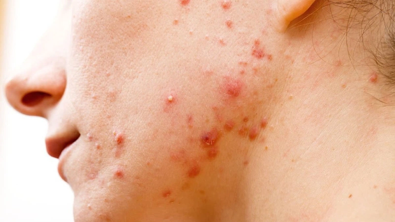 Quy trình skincare ngày và đêm cơ bản cho da mụn dầu