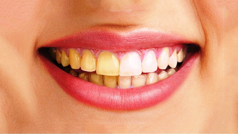 Răng ố vàng: Nguyên nhân, tác hại và cách khắc phục 3
