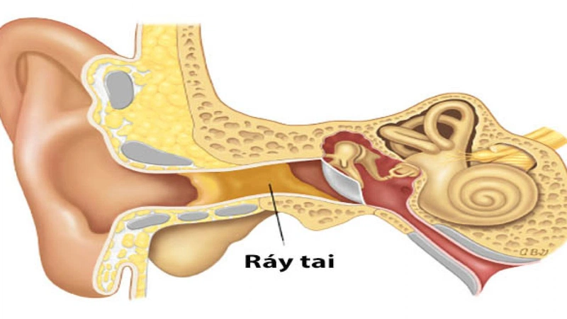 Ráy tai nhiều có tốt không? 1