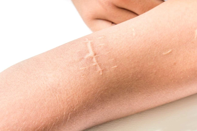 Sẹo lồi màu trắng có chữa khỏi được không? 1