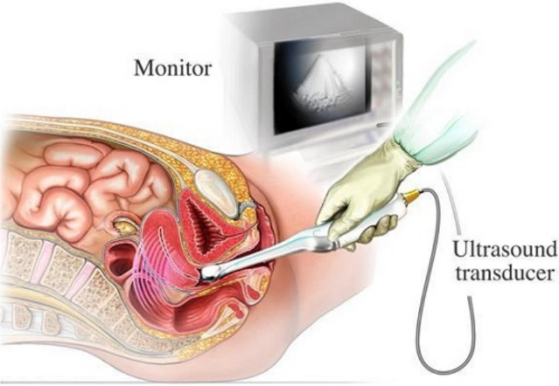 Siêu âm có phát hiện buồng trứng đa nang không? - Nhà thuốc FPT Long Châu