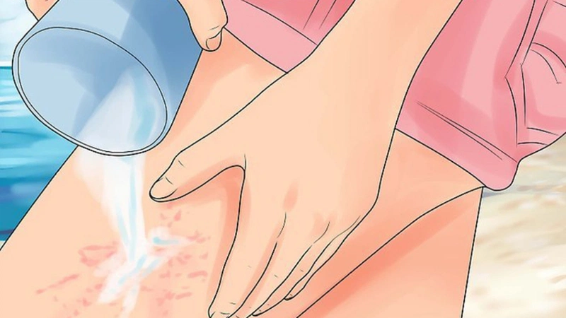 Sứa biển cắn uống thuốc gì? Cách xử lý vết thương khi bị sứa biển cắn 3
