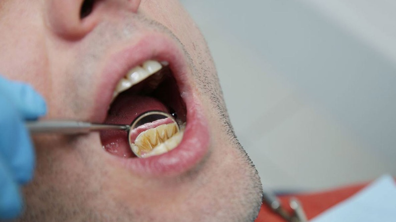 Sức khỏe răng miệng: Lấy cao răng nhiều có tốt không 1