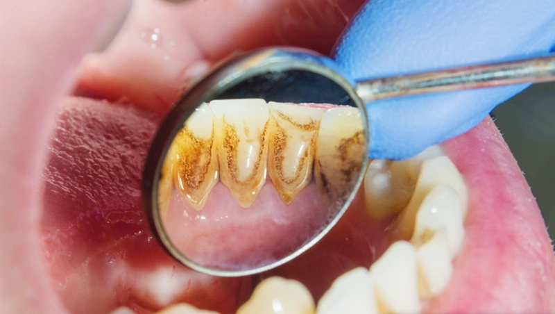 Sức khỏe răng miệng: Lấy cao răng nhiều có tốt không 2