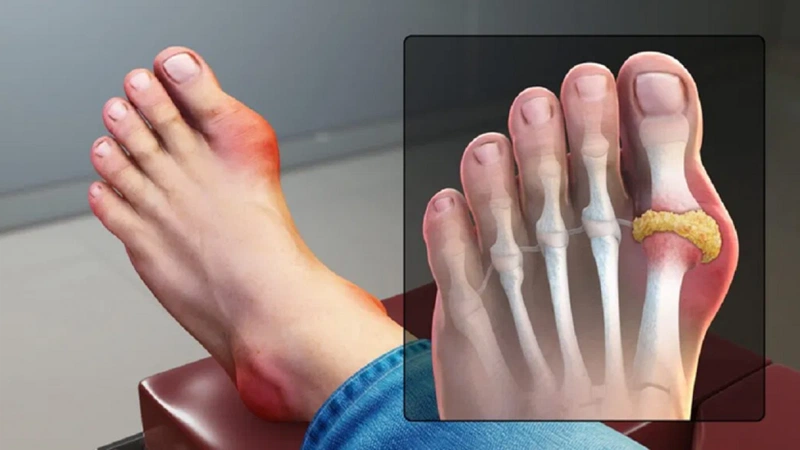 Sưng đau khớp bàn chân cái nguyên nhân do đâu? Cách khắc phục thế nào 2