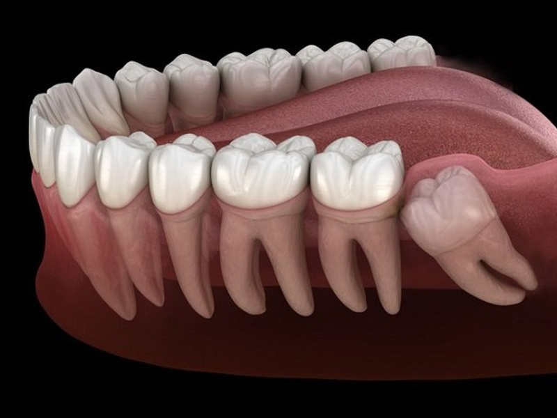 Sưng nướu răng khôn có tự khỏi không? 2