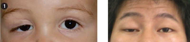 Sụp mí mắt do đâu? Phương pháp điều trị bệnh sụp mí mắt bạn cần biết 1