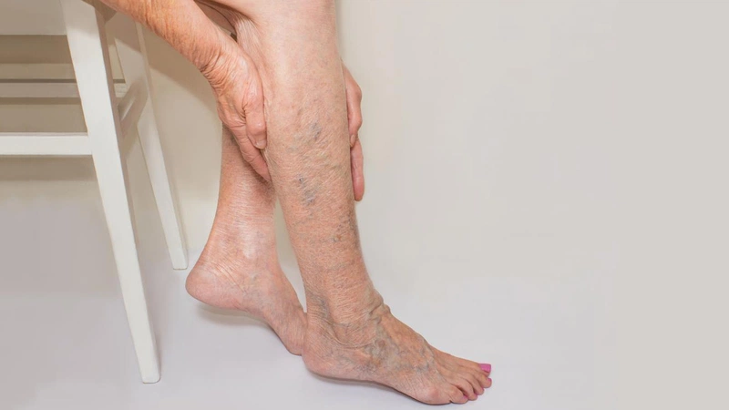Suy giãn tĩnh mạch chân có nguy hiểm không? Đối tượng nào dễ mắc bệnh 2