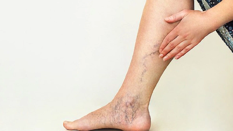 Suy giãn tĩnh mạch chi dưới để lâu có ảnh hưởng nhiều đến sức khỏe không 2