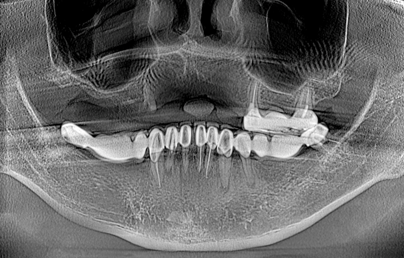 Tiêu xương hàm là gì? Tiêu xương hàm có niềng răng được không? 1
