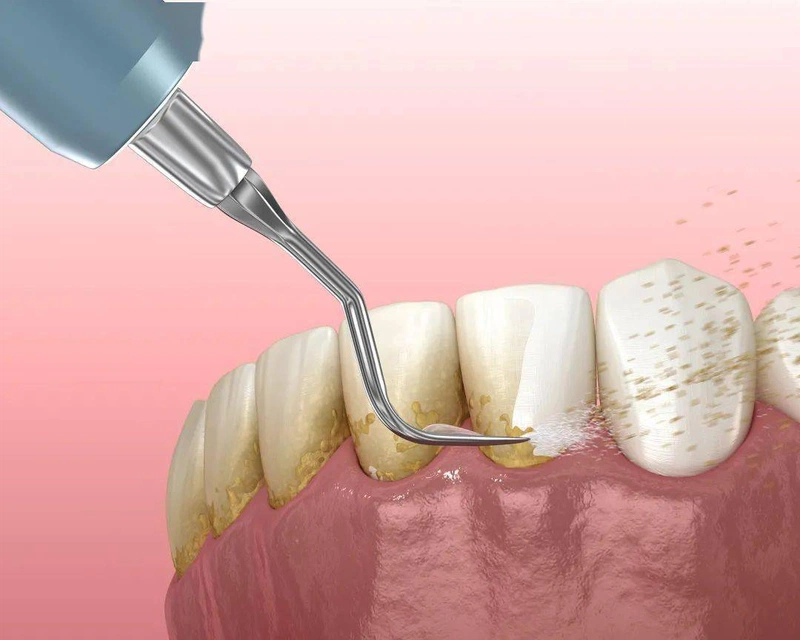 Tác hại của việc lấy cao răng sai cách bạn cần tuyệt đối tránh 2