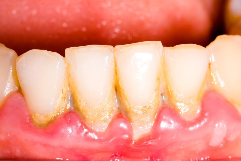 Tại sao nhiều nha sĩ luôn khuyến khích phải lấy cao răng định kỳ 1