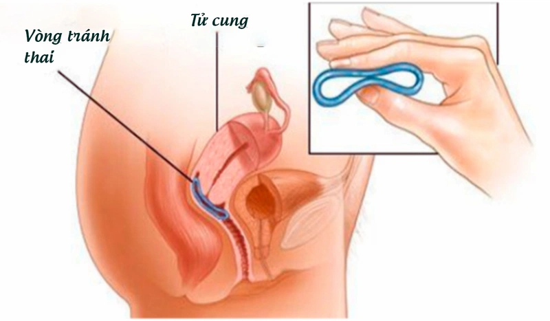 Cách tránh thai sau khi quan hệ không cần thuốc