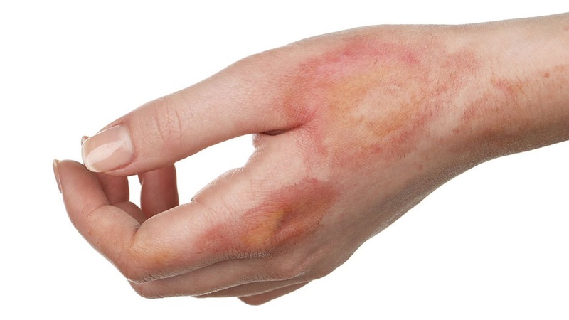 Tiết lộ cho bạn cách chữa cháy nắng với nha đam đơn giản tại nhà 1