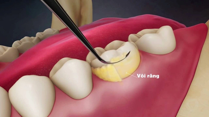Lợi ích của lấy cao răng thường xuyên: phát hiện sớm bệnh răng miệng