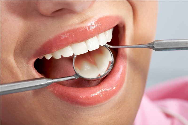 Lợi ích lấy cao răng thường xuyên: ngăn ngừa hôi miệng