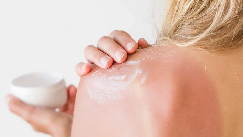 Tiết lộ một số cách chữa da cháy nắng bằng sữa chua 1